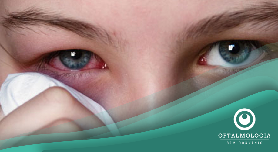 CONJUNTIVITE: MOTIVOS PARA FICAR DE OLHO NESTA DOENÇA